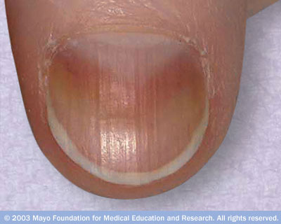 Vertical nail ridges, which run from the cuticle to the tip of the nail,